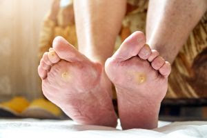 Uma a cada quatro pessoas com diabetes sofre com úlceras nos pés que podem levar à amputação